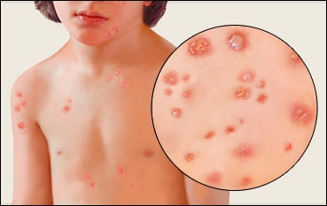 Chickenpox images