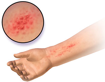 Dermatitis