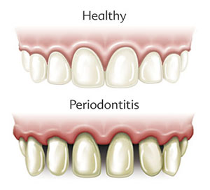 Healthy Gums