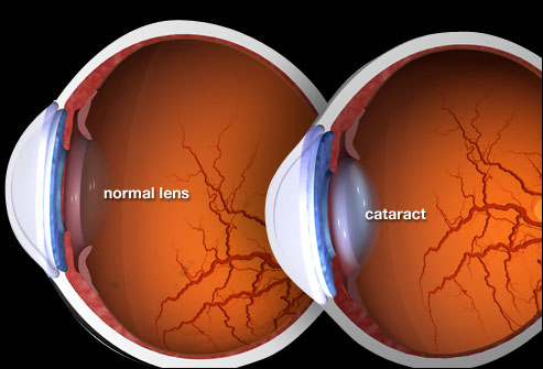 Cataract images - Ayurvedic Medicines for Cataract