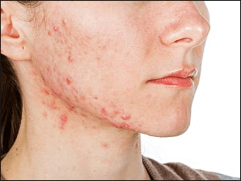 Acne Acne, Herbal Remedies for Acne