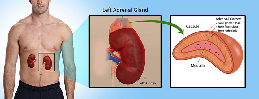 Hypocortisolism, Addisons disease