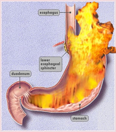 Agni Agni in Ayurveda