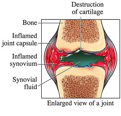 Rheumatoid arthritis Amavata, Ayurveda, Rheumatoid arthritis