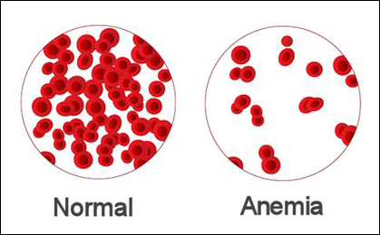 Anaemia