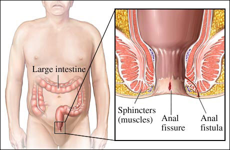 Anal Fistula - Ayurvedic Treatment of fistula Ano