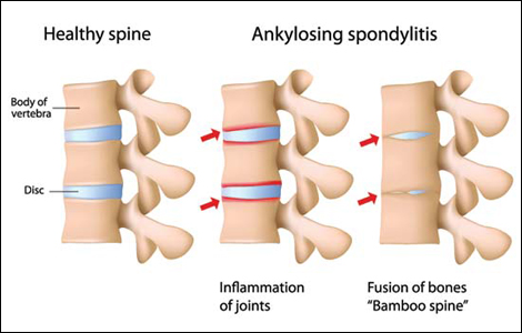 Ankylosing spondylitis