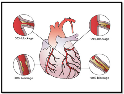 artery blockage artery blockage