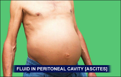 Ascites Fluid - Ascites Symptoms and Signs Images