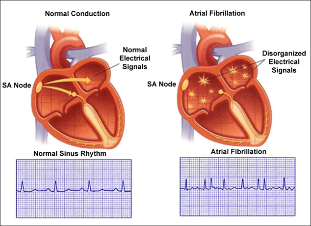 Atrial Fibrillation