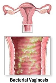 bacterial vaginosis