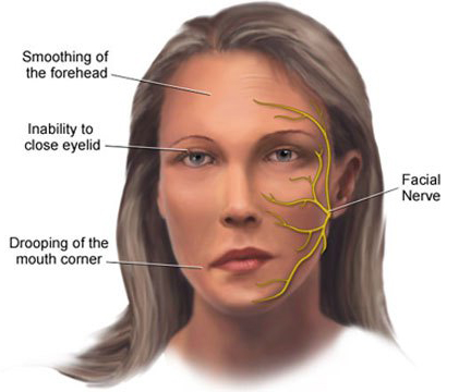 Bell's palsy Bell's palsy