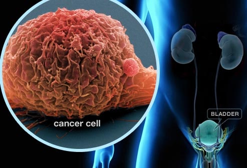 Bladder Cancer Bladder Cancer