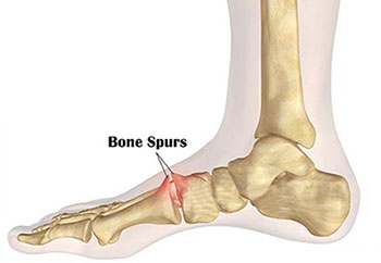 Home Remedies for Bone Spur - Natural 