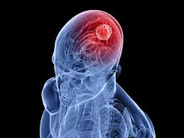 Brain Tumors Brain Tumors