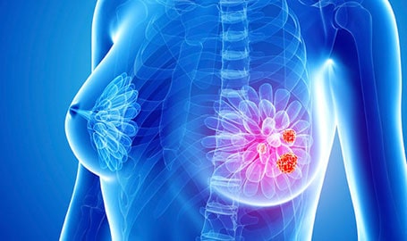 Breast Cancer