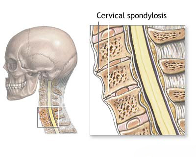 Cervical Spondylitis Cervical Spondylitis