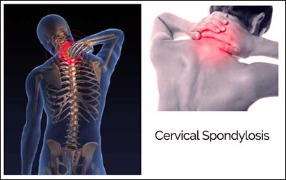 Cervical Spondylosis