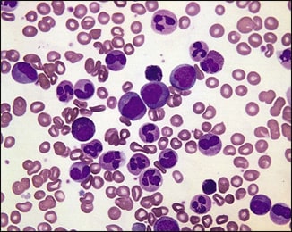 Chronic Myeloid Leukemia Chronic Myeloid Leukemia