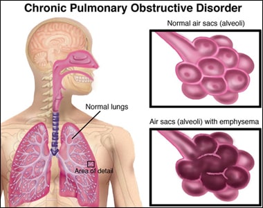 Chronic Obstructive Pulmonary Disease (COPD)