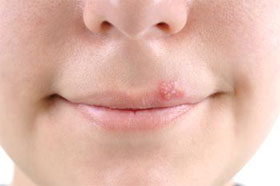 Cold Sores