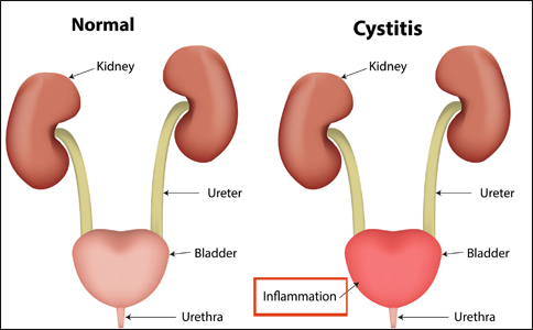 Cystitis