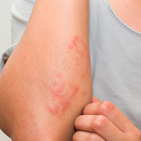 Dermatitis and Eczema