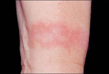 Dermatitis
