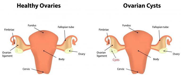 What Are Ovarian Cysts? What are Ovarian Cysts?