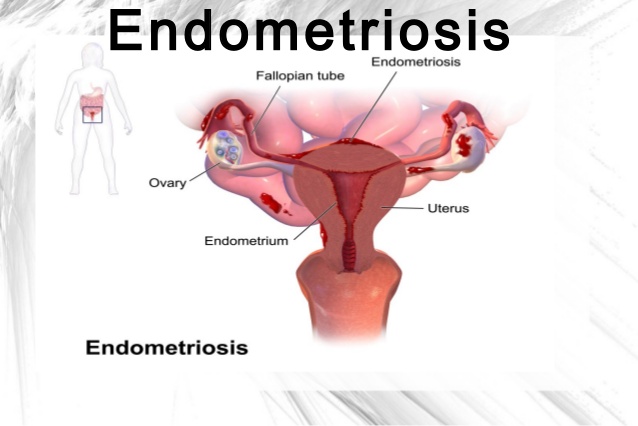 Endometriosis Endometriosis