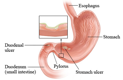 Duodenal Ulcer