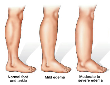 Edema