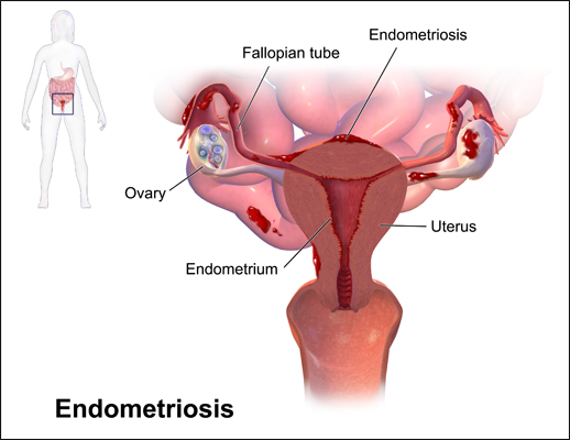 Endometriosis Endometriosis