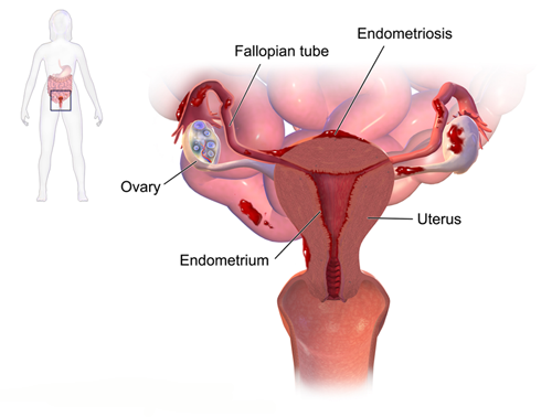 Endometriosis