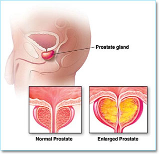Enlarged Prostate Gland