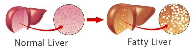 Fatty liver Fatty liver
