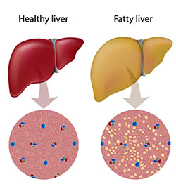 Fatty Liver Diet Chart In Hindi