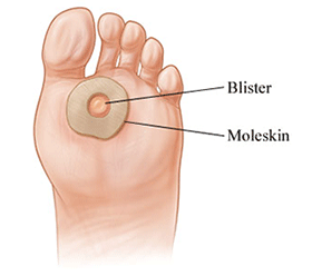 How To Prevent & Treat Blisters - Adventure Equipped