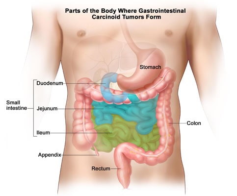 Gastrointestinal Carcinoid Tumor
