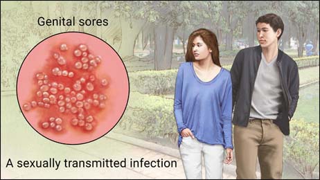 Genital herpes