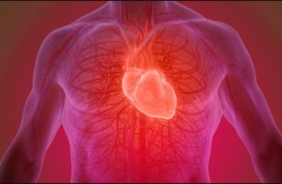 Hypertrophic cardiomyopathy