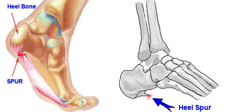 Home Remedies for Heel Spur Natural Treatment