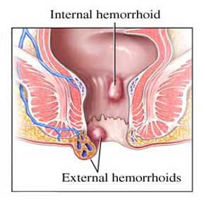 Piles (Hemorrhoids) Piles(Hemorrhoids)
