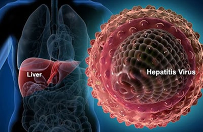 Prostatitis hepatitis)