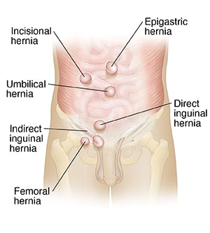 Pediatric Infant Bilateral Open Inguinal Hernia Repair Twin A