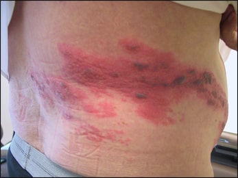 Herbal Remedies For Herpes Zoster Ayurvedic Treatment Causes