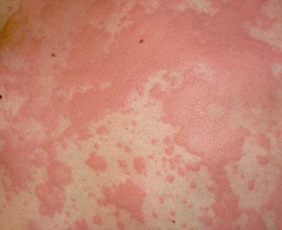 Urticaria