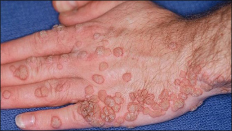 papillomavirus infection