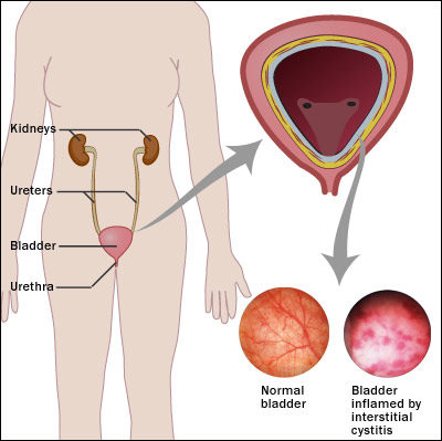 Interstitial cystitis Interstitial cystitis