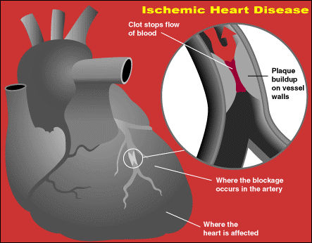 Ischemic Heart Disease Ischemic Heart Disease